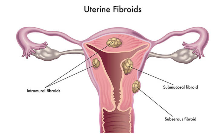 Fibroids in pregnancy