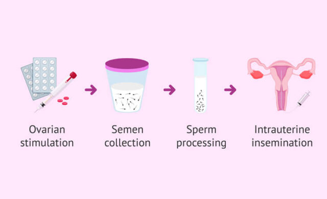 Semen Preparation Techniques For Intrauterine Insemination