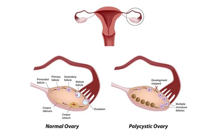 PCOS Treatment