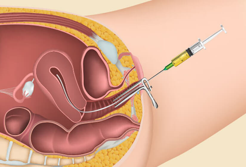 Frozen embryo transfer success rate